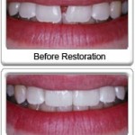 before & after dental bonding