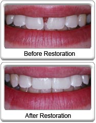 Teeth Bonding For Gaps Procedure
