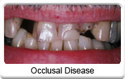 Occlusal Disease