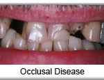 Occlusal damage related to TMJ