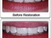 Closing Spaces between Teeth with Dental Bonding