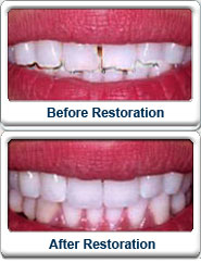 Before After Smile Makeover Veneers