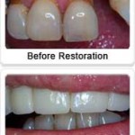 Fixed Dental Bridge Fixed Dental Bridge