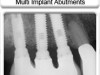 Dental Implants - Multiple Configuration