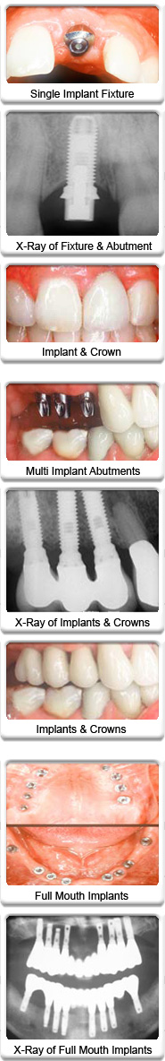 Dental Implants