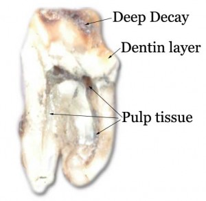 endodontics-cutaway