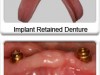 The Benefits of Implant Retained Dentures