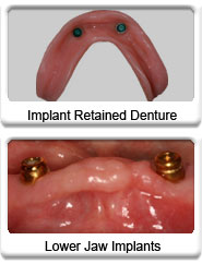 implant retained dentures