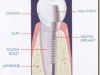 Dental Implant Inside Tooth