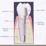 Dental Implant Inside Tooth