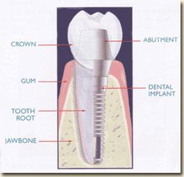 Dental Implant Inside Tooth