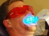 Laser Whitening Accelerator