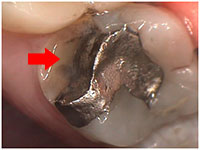 Occlusal damage -broken tooth