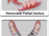 Partial Dentures