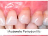 Something You Should Know About Periodontal Disease