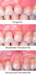 periodontal disease stages