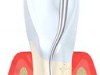 Cross section of tooth and gum line.