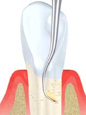 Tooth and Gumline