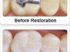 Tooth Colored White Fillings