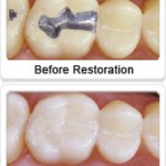 Tooth Colored White Fillings Tooth Colored White Fillings